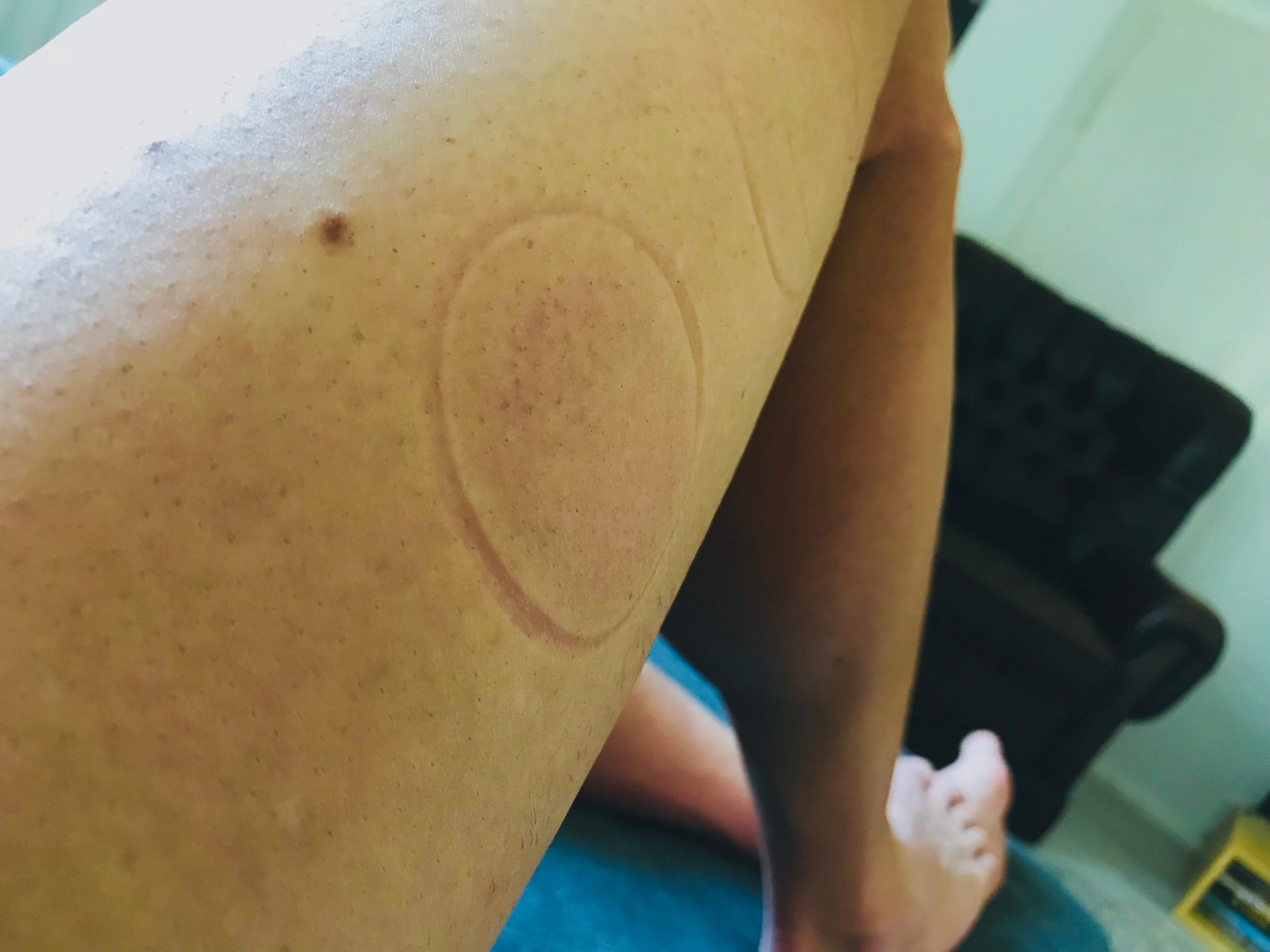 Kreisrunder rötlicher Abdruck eines Schröpfglases auf dem Oberschenkel nach dem trockenen Schröpfen