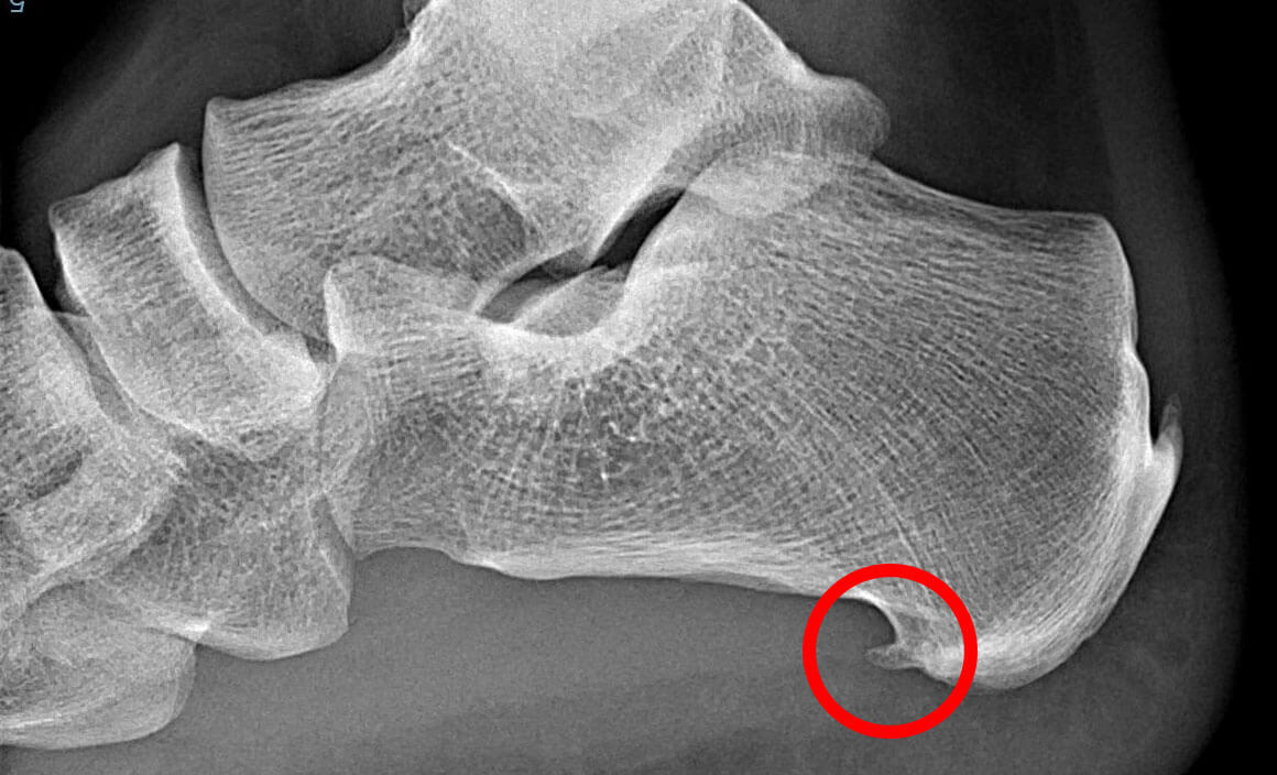 Fersensporn Röntgenbild